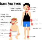 types of eczema ireland,