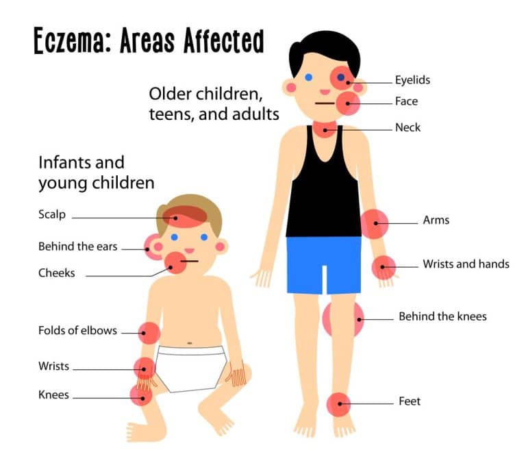 eczema treatment,