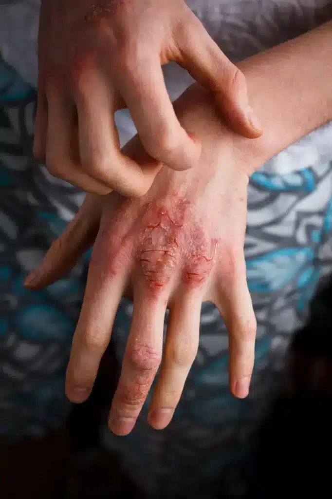 Photo shoPhoto showing mild contact dermatitis on hands with redness and flaking skin.wing mild contact dermatitis on hands with redness and flaking skin.