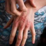 contact dermatitis on hands