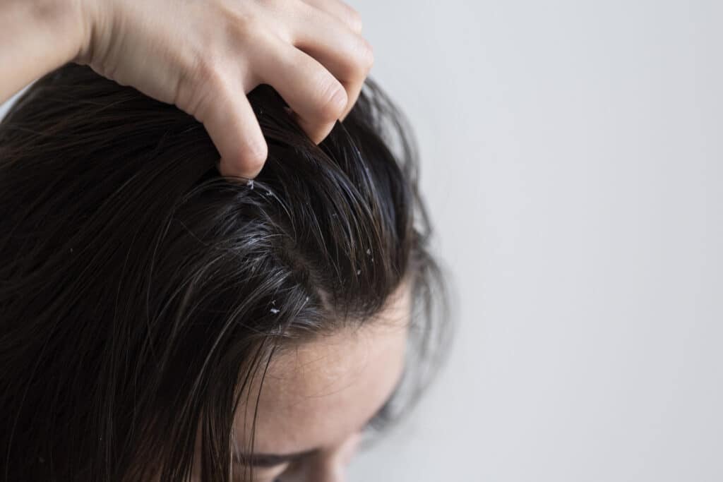 a woman with seboorheic dermatitis on her head