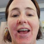 perioral dermatitis around a ladies mouth