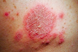 nummular eczema on the leg