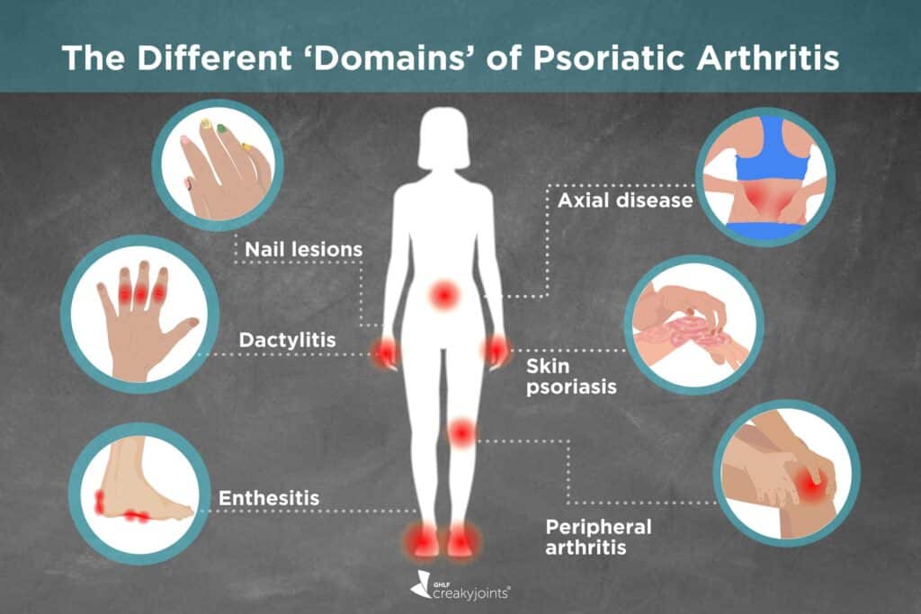 Diagram showing joints commonly affected by psoriatic arthritis with highlighted areas of inflammation and swelling.