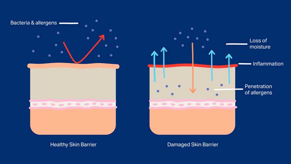 damaged skin barrier