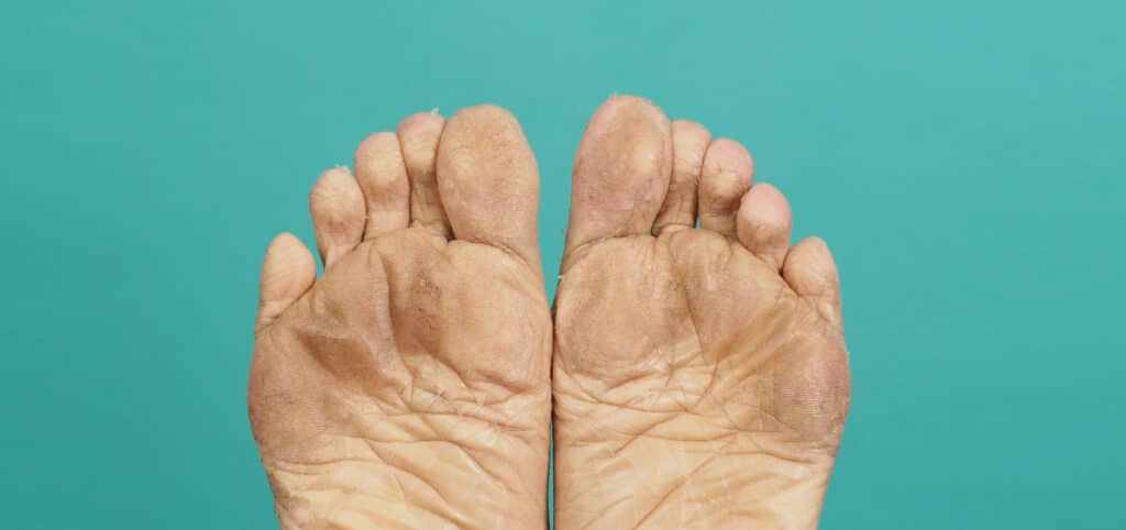 psoriatic arthritis soles of feet