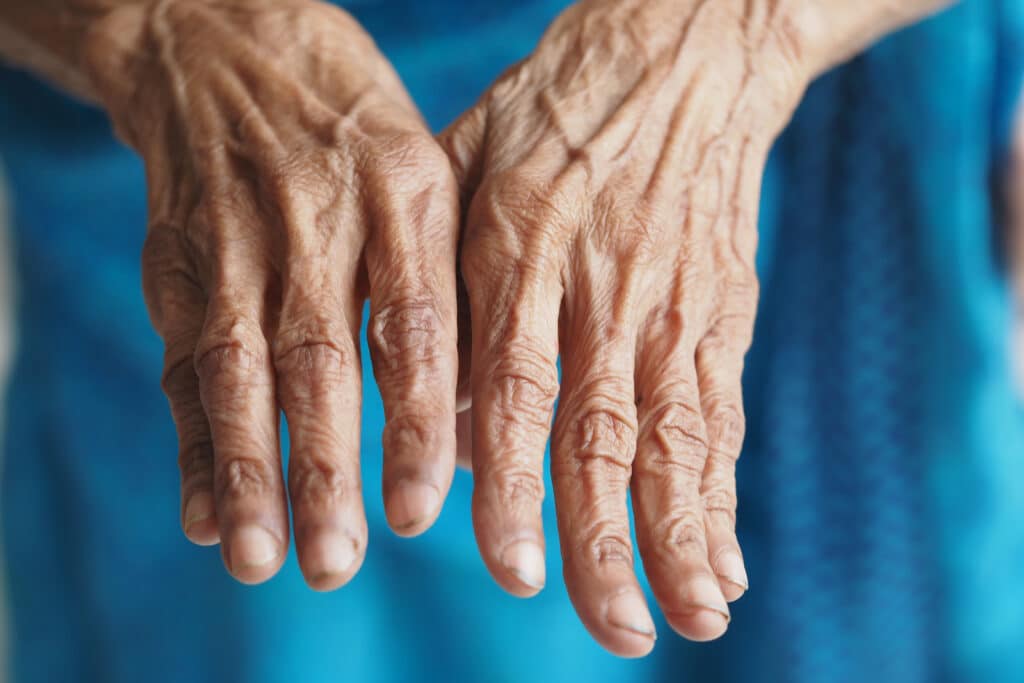 Psoriatic Arthritis fingers
