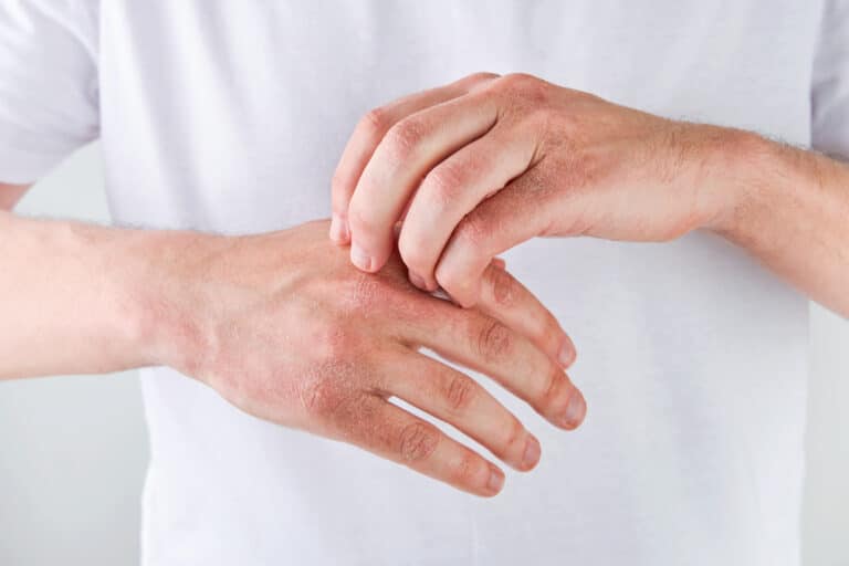 psoriasis and joint pain on hands,