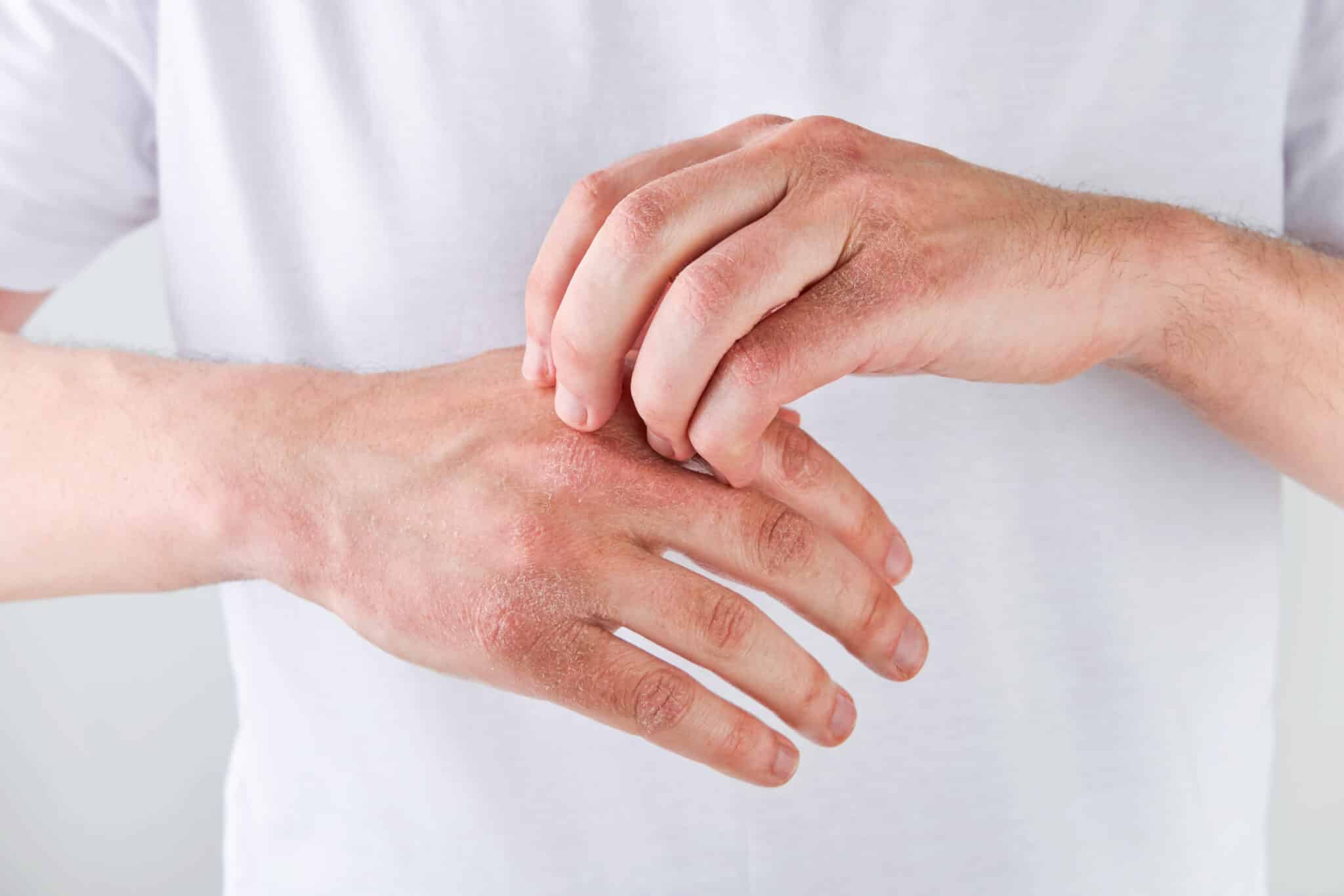 psoriasis and joint pain on hands,