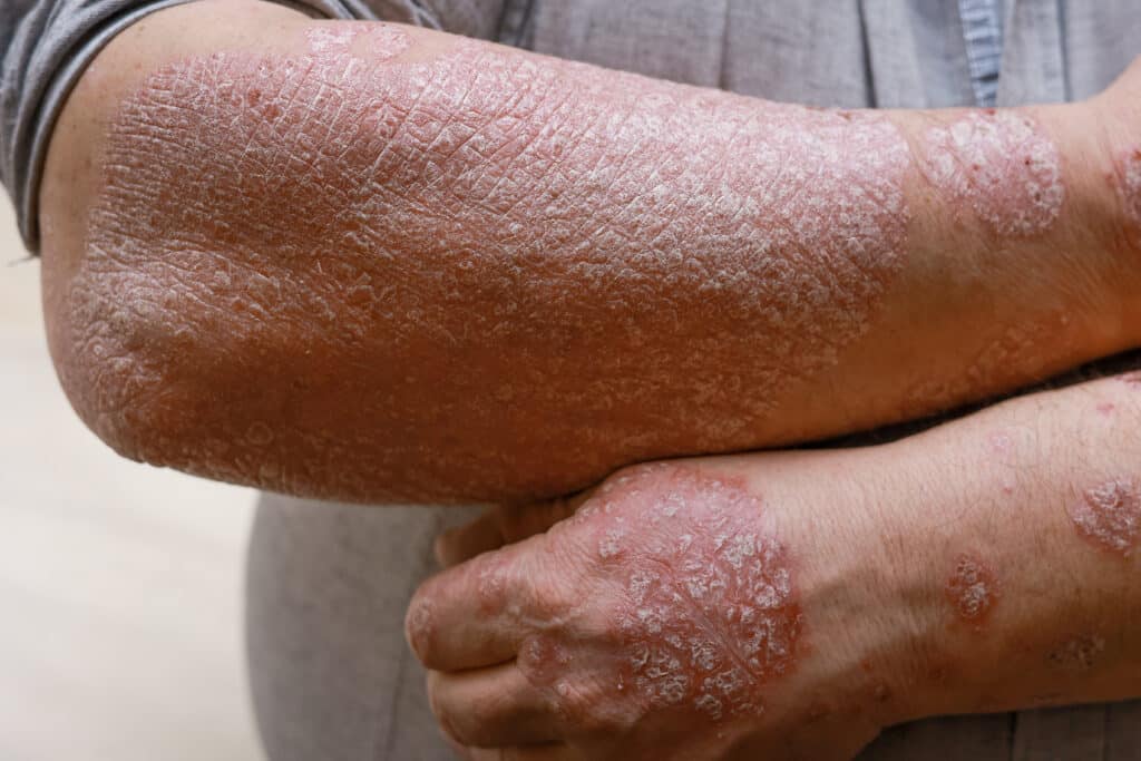 psoriasis on the arms