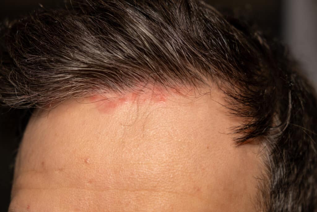 photo of a person suffering with scalp eczema