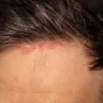 photo of a person suffering with scalp eczema