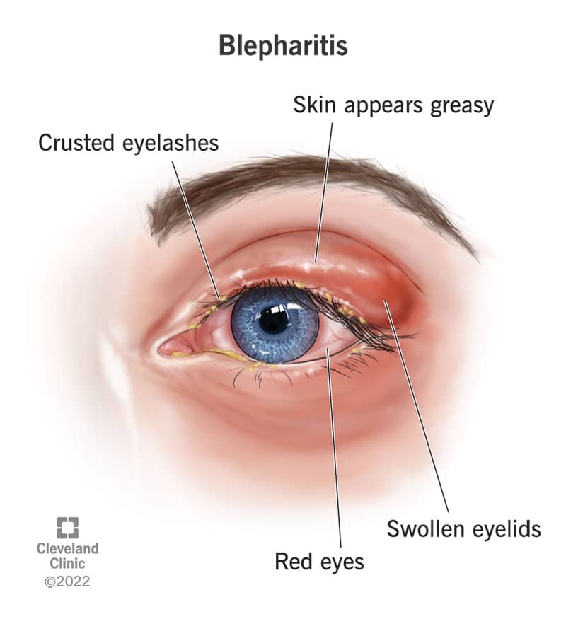 diagram of blepharitis