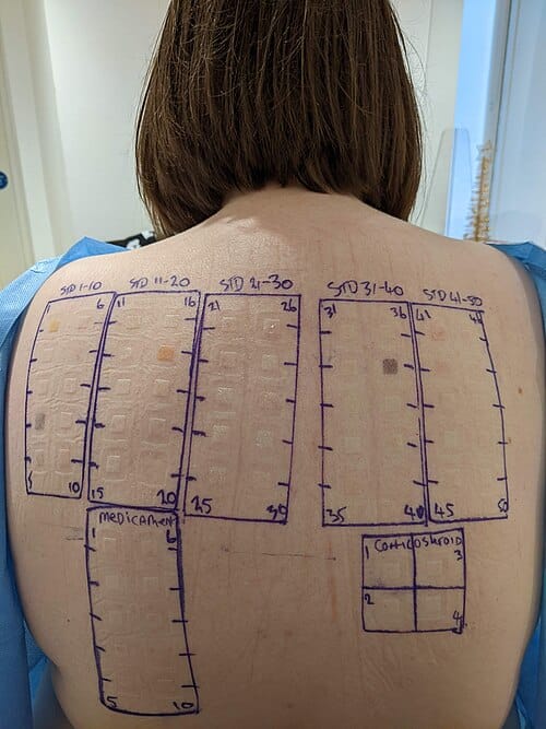 patch testing on a ladies back