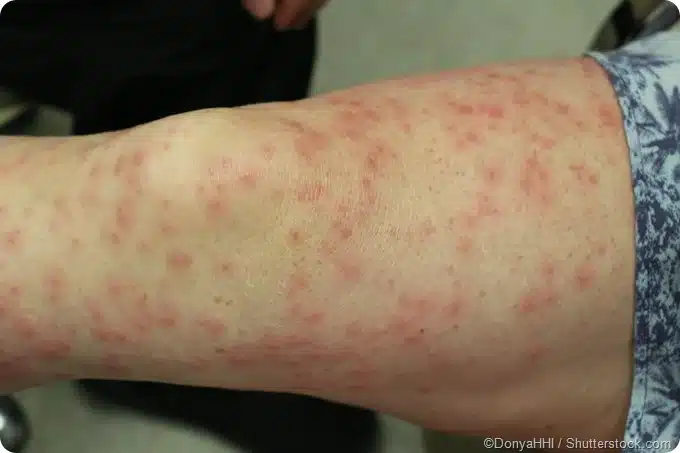 contact dermatitis on the arm