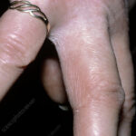 DYSHIDROTIC ECZEMA BETWEEN FINGERS