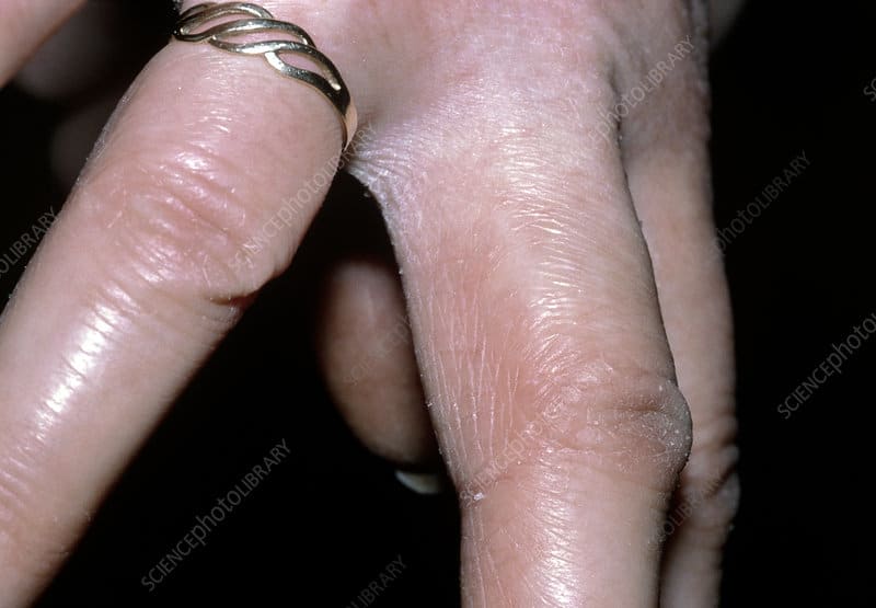 contact dermatitis between fingers