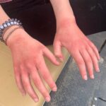 contact dermatitis on hands needing treatment