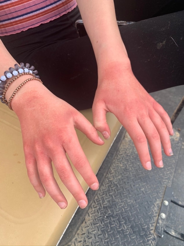 contact dermatitis on hands needing treatment