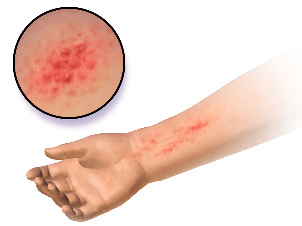 graphic of dermatitis on an arm