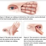 corner of eye eczema irritants