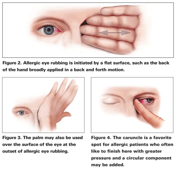 corner of eye eczema irritants