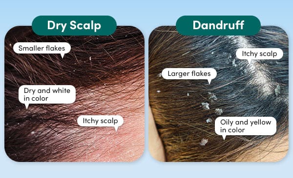 graphic explaining the difference between dry scalp and dandruff