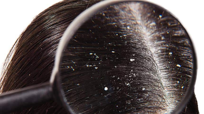 close-up of scalp covered in dandruff