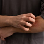 contact dermatitis on a man's arm
