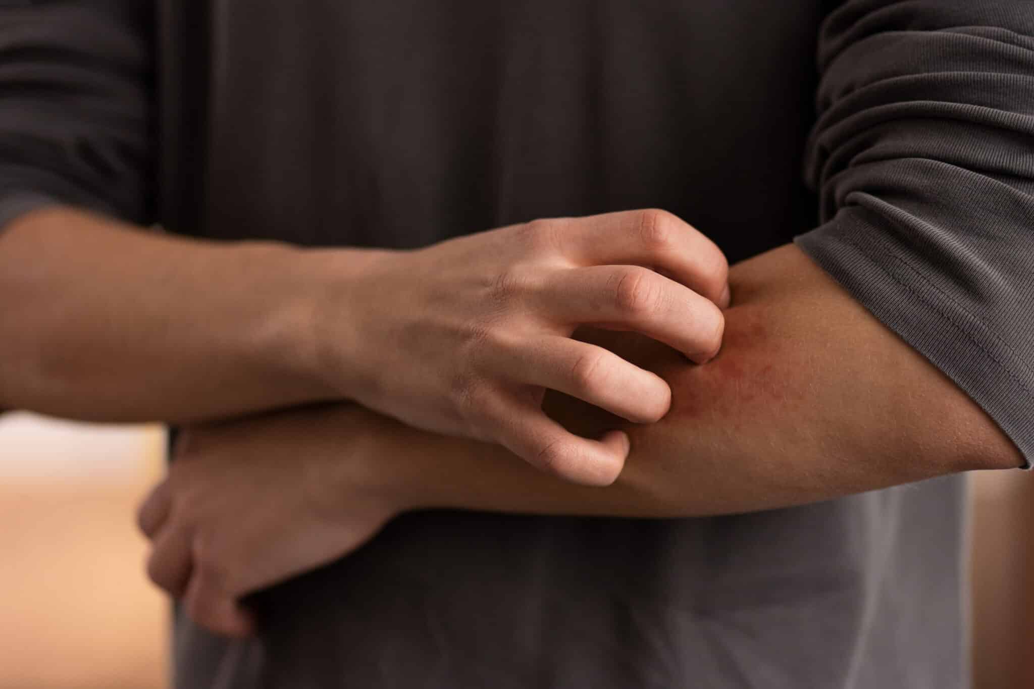 contact dermatitis on a man's arm