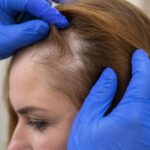 woman having scalp eczema examined.